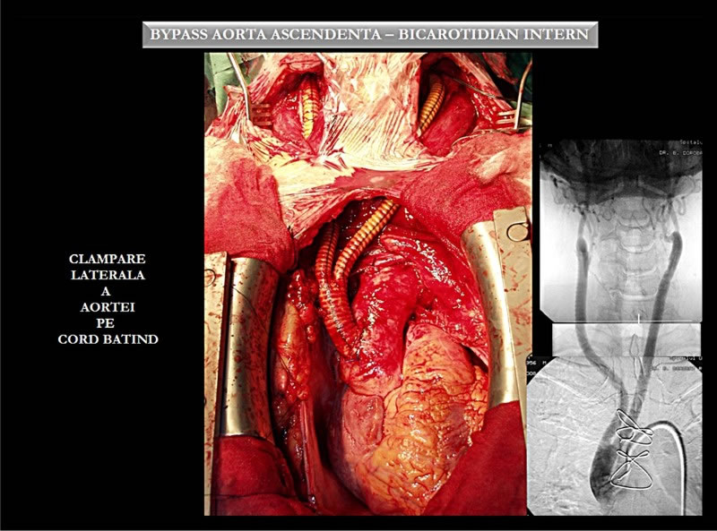 Muresian - clamparea laterala a aortei
