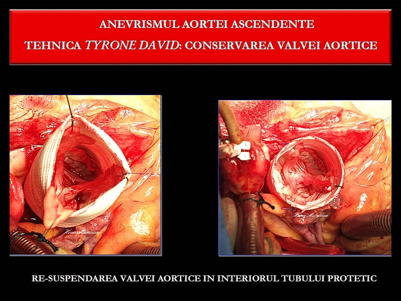 Muresian - anevrismul aortei ascendente