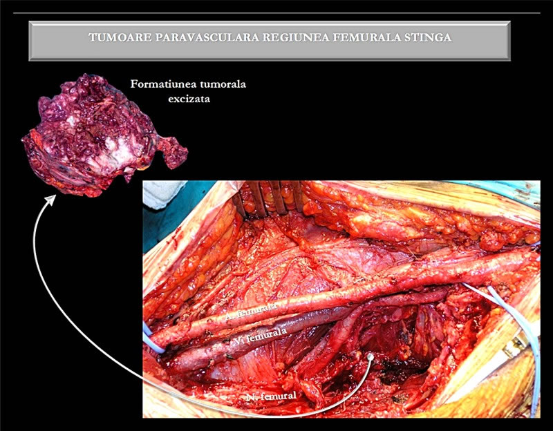 Muresian - formatiune tumorala regiunea femurala